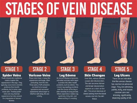 Stasis Dermatitis Varicose Veins And Skin Problems - vrogue.co