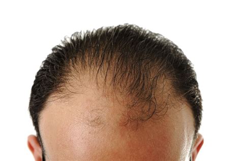 Foreskin May Help Cure Male-Pattern Baldness -- The Cut