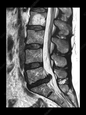 Large L5 S1 Disc Herniation MRI - Stock Image - C043/0183 - Science Photo Library