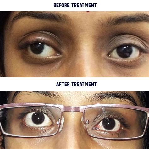 Squint or Strabismus Causes and treatment - Vision Eye Center