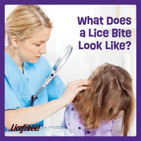 What does a lice bite look like? | Licefreee