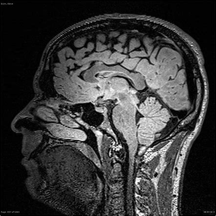 Epilepsy protocol (MRI) | Radiology Reference Article | Radiopaedia.org