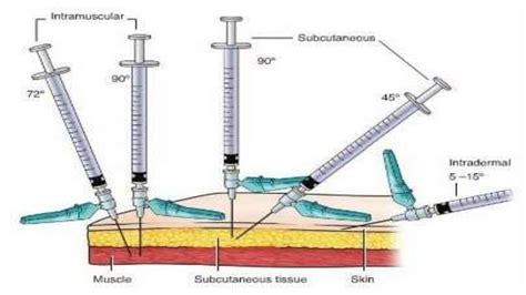 Intradermal injections