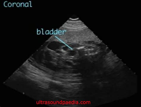 Sacrococcygeal teratoma – ULTRASOUNDPAEDIA