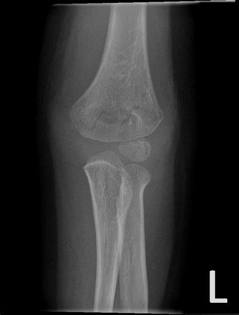 6 year old child with Trauma to Elbow