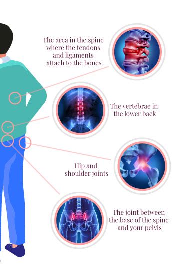 Symptoms of Ankylosing Spondylitis – Good Health We Care