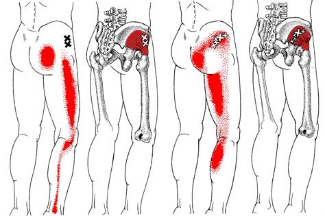 Myofascial Pain Syndrome - trigger point pain referral from the Glute. Medius muscle