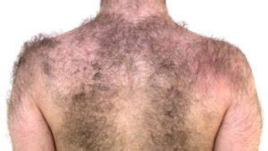 Excess Body Hair - Causes, Symptoms And Risk Factors