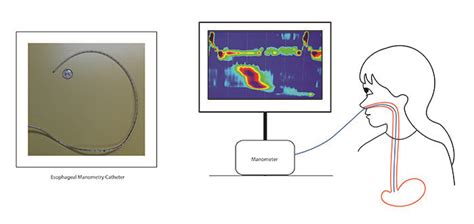 GiKids - Esophageal Manometry