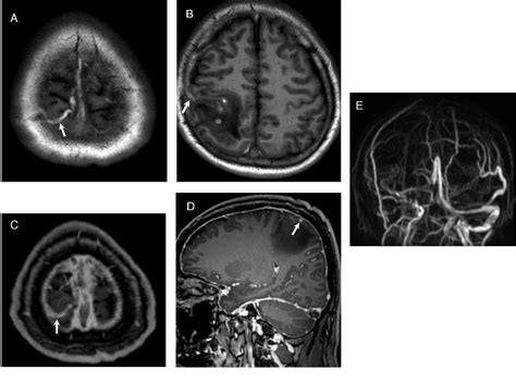 Figure 1 from MRI diagnosis of dural sinus—Cortical venous thrombosis ...