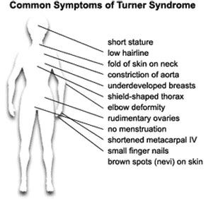 Symptoms & Characteristics - Turner Syndrome