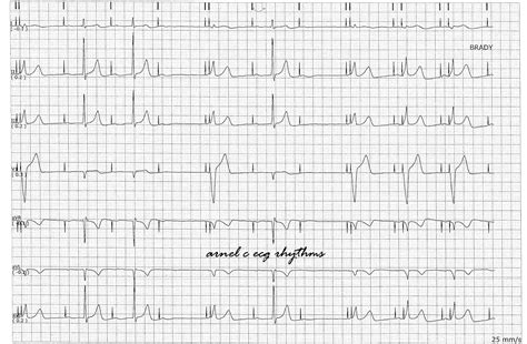 ECG Rhythms: Managed Ventricular Pacing