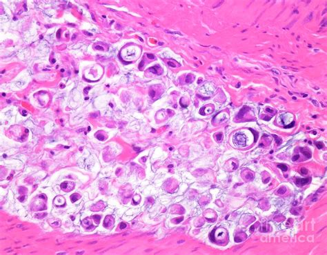 Signet Ring Cell Carcinoma Of The Colon Photograph by Webpathology/science Photo Library