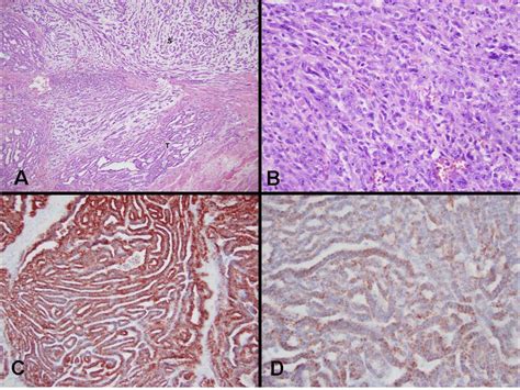 A. Mucinous tubular and spindle cell carcinoma of kidney. Tubules (T)... | Download Scientific ...