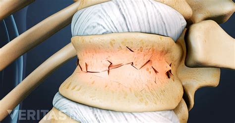 Vertebral Fracture Symptoms