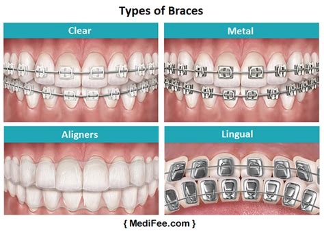 Dental Braces Treatment in India