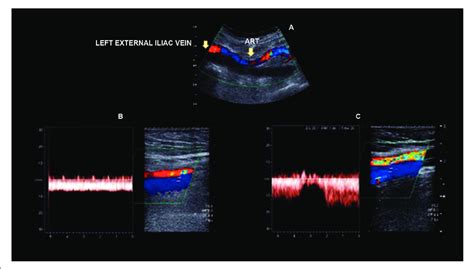 -Left external iliac vein thrombosis: flow comparison between the left... | Download Scientific ...