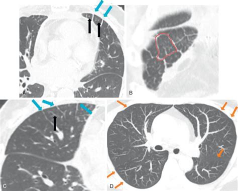 Normal Anatomy of the Lungs | Radiology Key