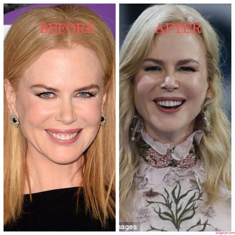 Nicolas Kidman Before And After Plastic Surgery: A Comprehensive Analysis