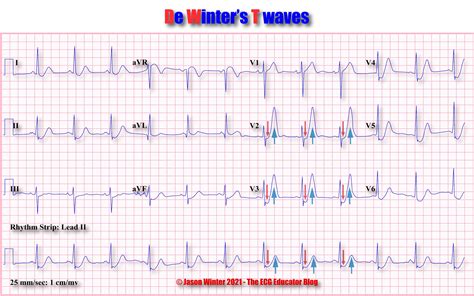 ECG Educator Blog : De Winters T waves