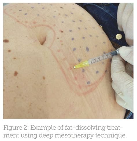 Utilising Fat-dissolving Injections - Aesthetics