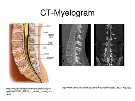 PPT - Spinal Cord Compression PowerPoint Presentation - ID:851177