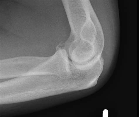 Coronoid Process Fracture | The Bone School