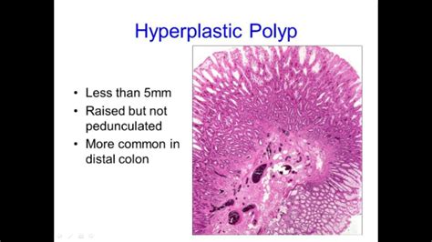 Hyperplastic Polyps: Not Always What They Seem - YouTube