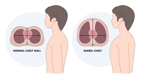 5 Barrel Chest Deformity Royalty-Free Images, Stock Photos & Pictures ...