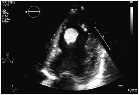 Management Of Lv Thrombus | Paul Smith