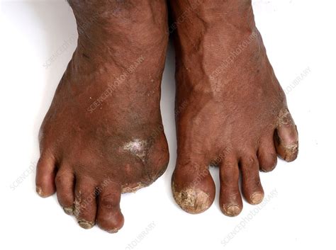 Amputated toes in diabetes - Stock Image - C037/2075 - Science Photo Library