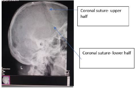 [PDF] Study of Pattern of Fusion of Coronal Suture Using Skull Radiography and its Association ...