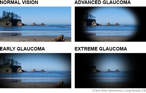 What is Glaucoma? - Weston Contact Lens Institute