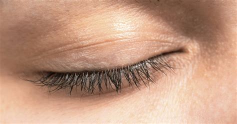 Sagging eyelids more common in some