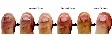 Onychomycosis - We have the solution - Reveal Beauty Clinic