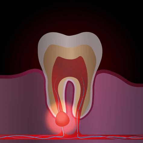 Tooth Nerve Pain: Causes And Treatments