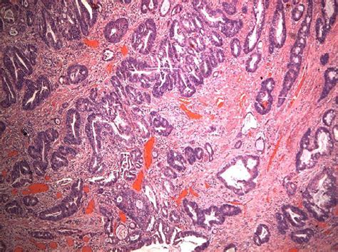 Pathology Outlines - Adenocarcinoma of GE junction