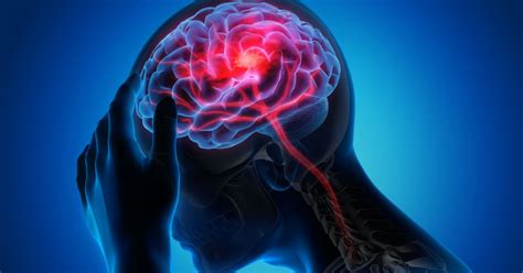 Cerebral Infarction - Symptoms, Treatment & Causes - health Guider