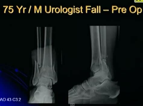 Pilon Fractures — OrthopaedicPrinciples.com