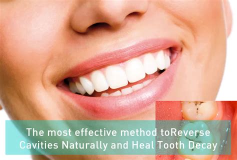 The most effective method to Reverse Cavities Naturally and Heal Tooth Decay