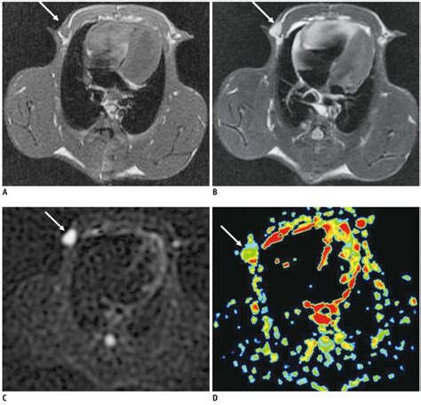 Appearance of conventional MRI, diffusion-weighted imaging and apparent... | Download Scientific ...