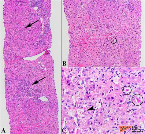 The Liver Biopsy: Importance and Interpretation | AASLD