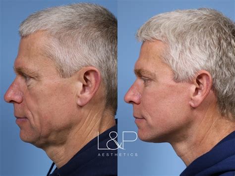 Laser Resurfacing (TRL) Before and After Photo Gallery | Palo Alto ...