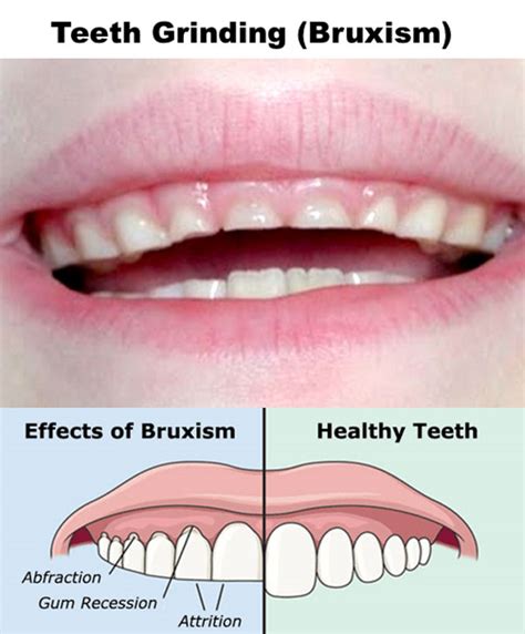 Teeth Grinding | Midland Park Family Dentistry