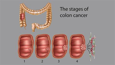 Liver And Bowel Cancer Survival Rates - CancerWalls