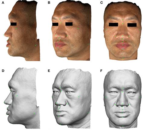 Acromegaly Face