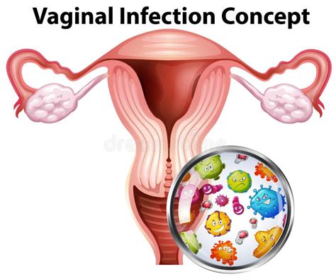 Vaginal Infection Bacteria Concept Stock Vector - Illustration of drawing, body: 118549743