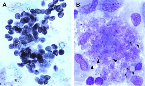 Pneumocystis Jirovecii