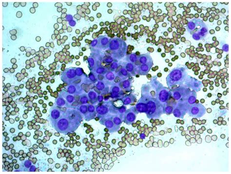 Cytological and molecular diagnosis of Hürthle cell thyroid tumors ...