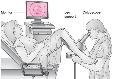 What To Avoid After A Colposcopy - What To Expect Before During And ...